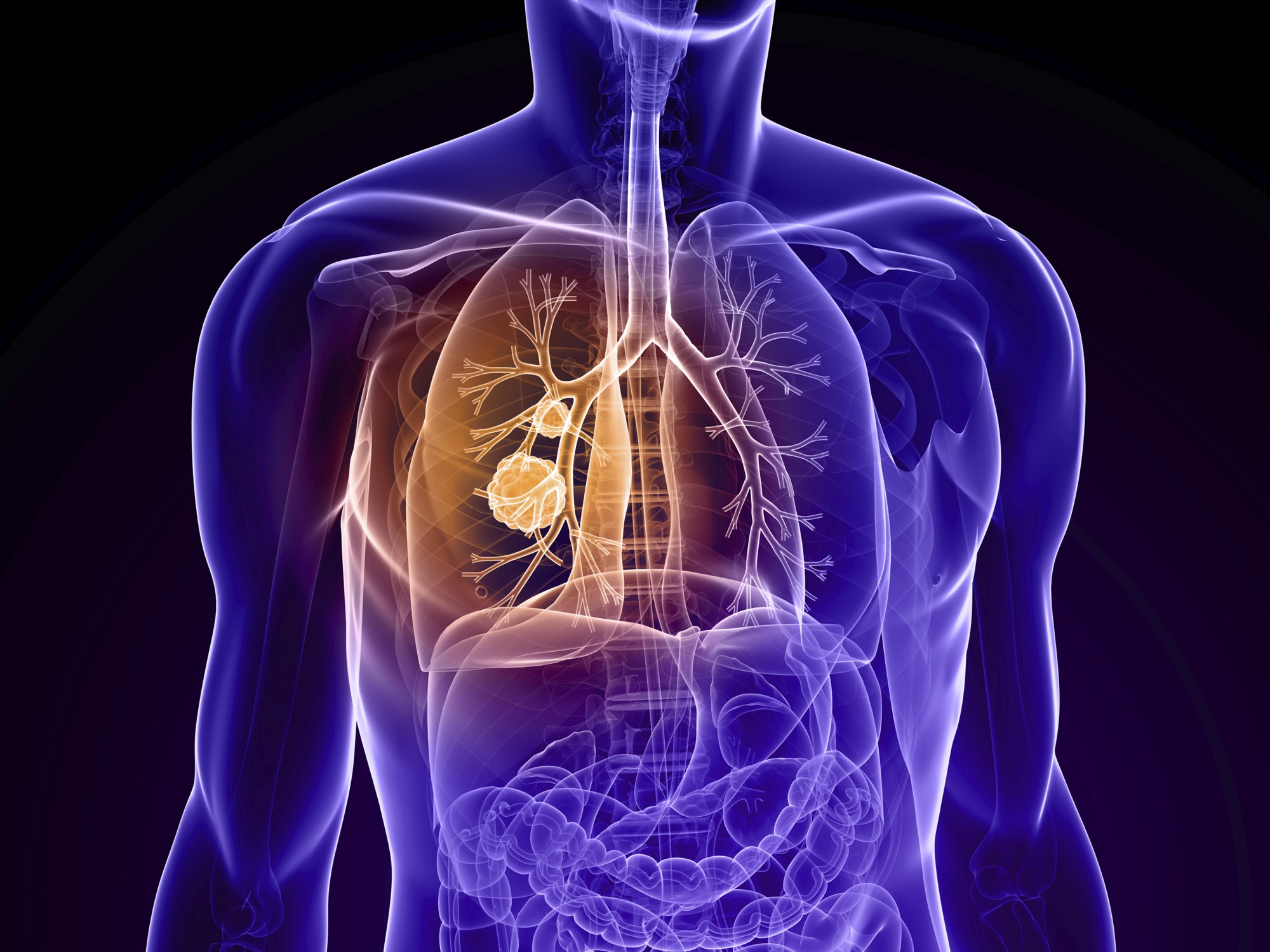 Lung Cancer Detection Using Low-Dose CT | CitiScan Radiology Brisbane